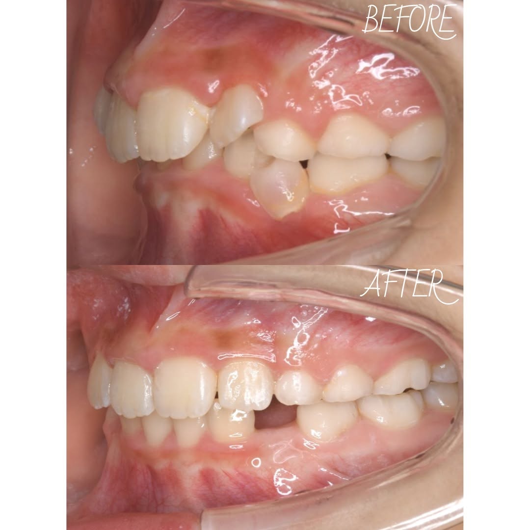 ガタガタした歯並びが気になる