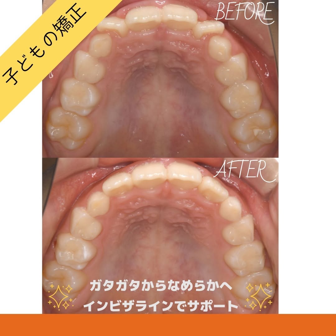ガタガタした歯並びが気になる
