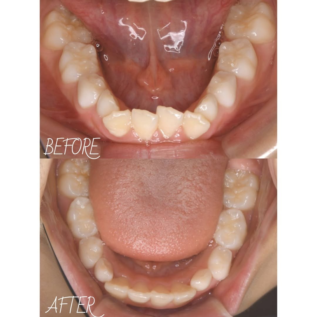 前歯のガタつきが気になる